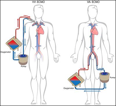 Extracorporeal membrane oxygenation support in oncological thoracic surgery
